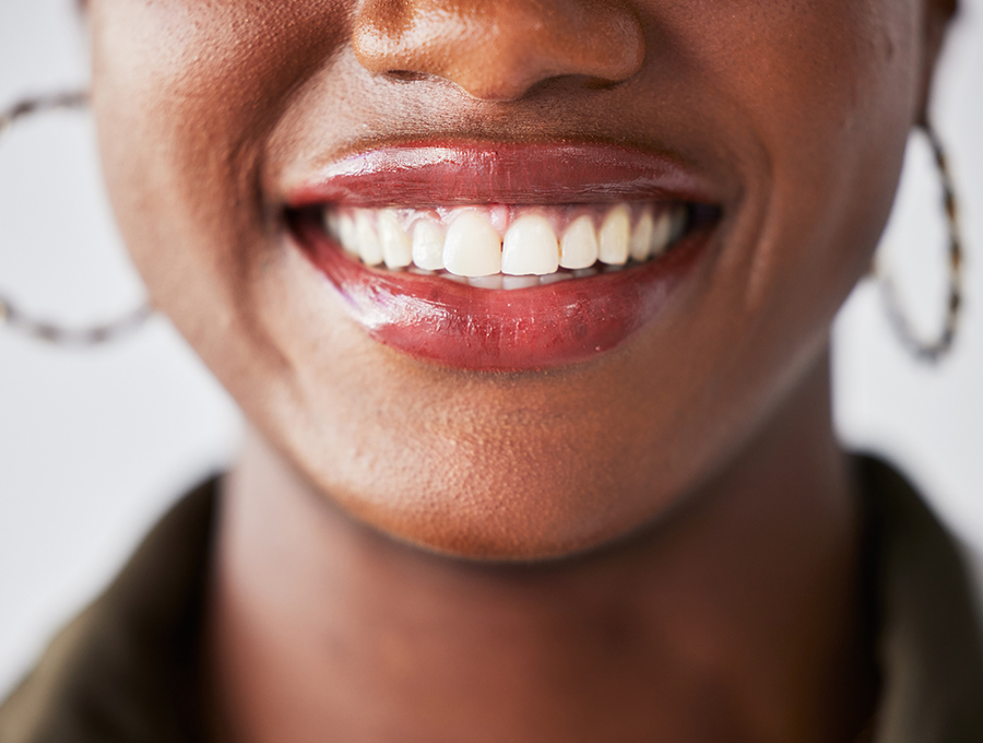 Smile-Makeover