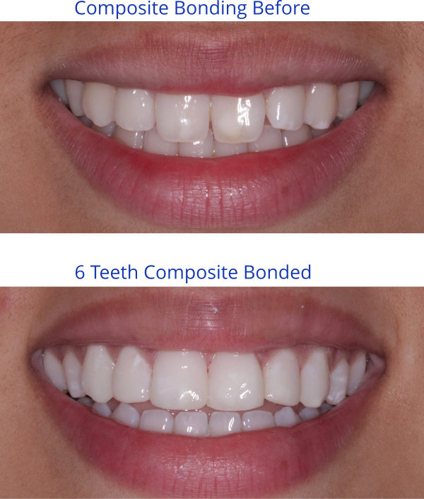 6 Teeth Composite Bonded