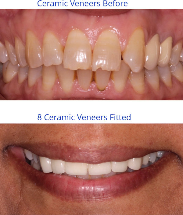 8 Teeth Porcelain Veneers